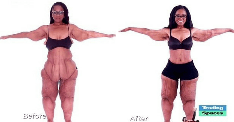 Woman who had mounds of sagging skin after losing 360lb transforms after surgery