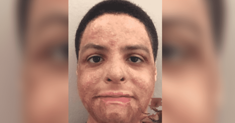 New York student permanently disfigured after suffering burns in botched chemistry experiment awarded $60 million