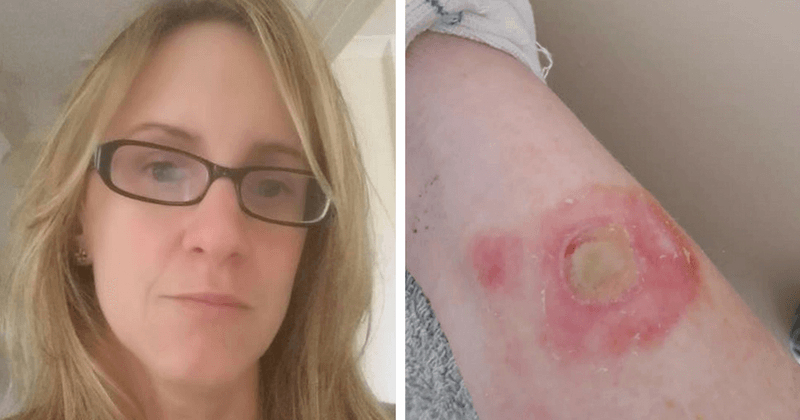 Mom's Facebook post warns about how children are burning their skin after taking on the dangerous Deodorant Challenge
