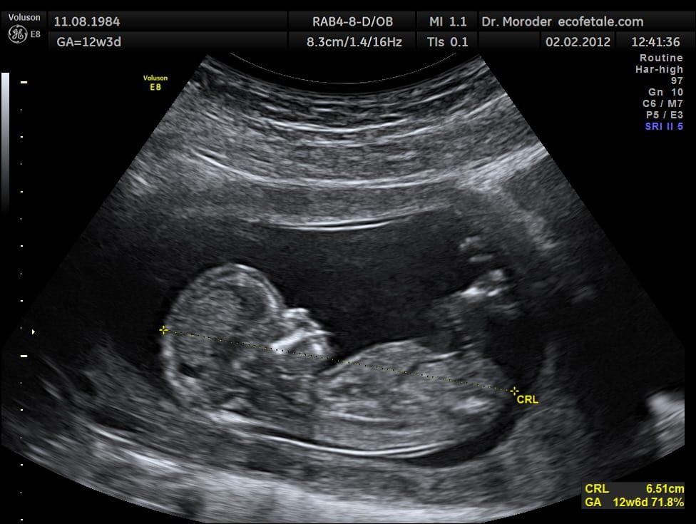 Tiesha Davis sued the Florida housing complex for demanding an ultrasound photo. (Wikipedia)