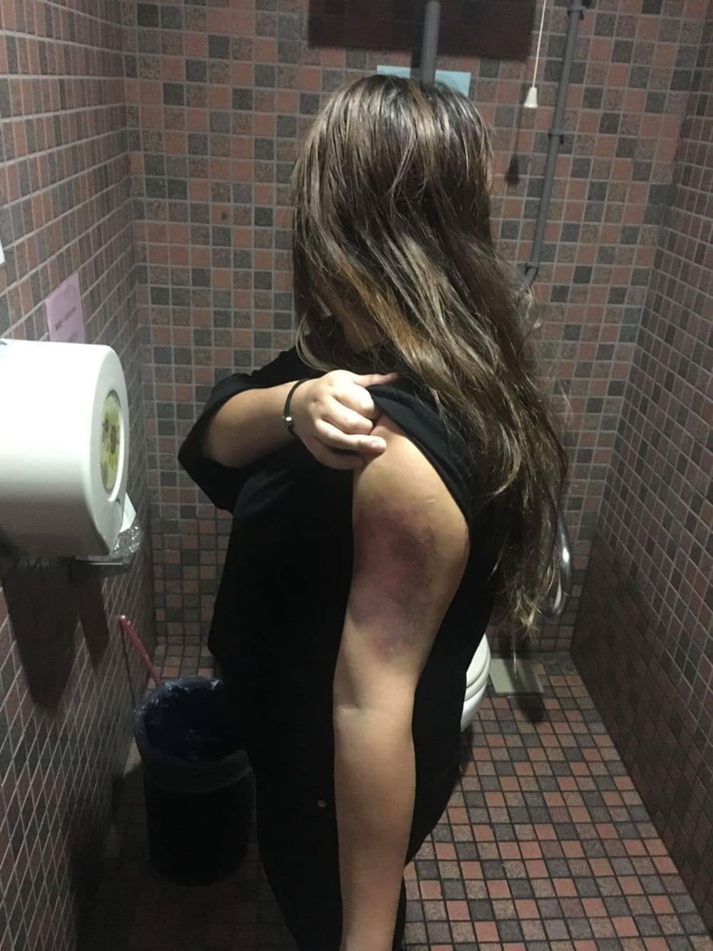 Injuries on a woman who claims to be Gary Chu's former wife (Source: Asiawire)