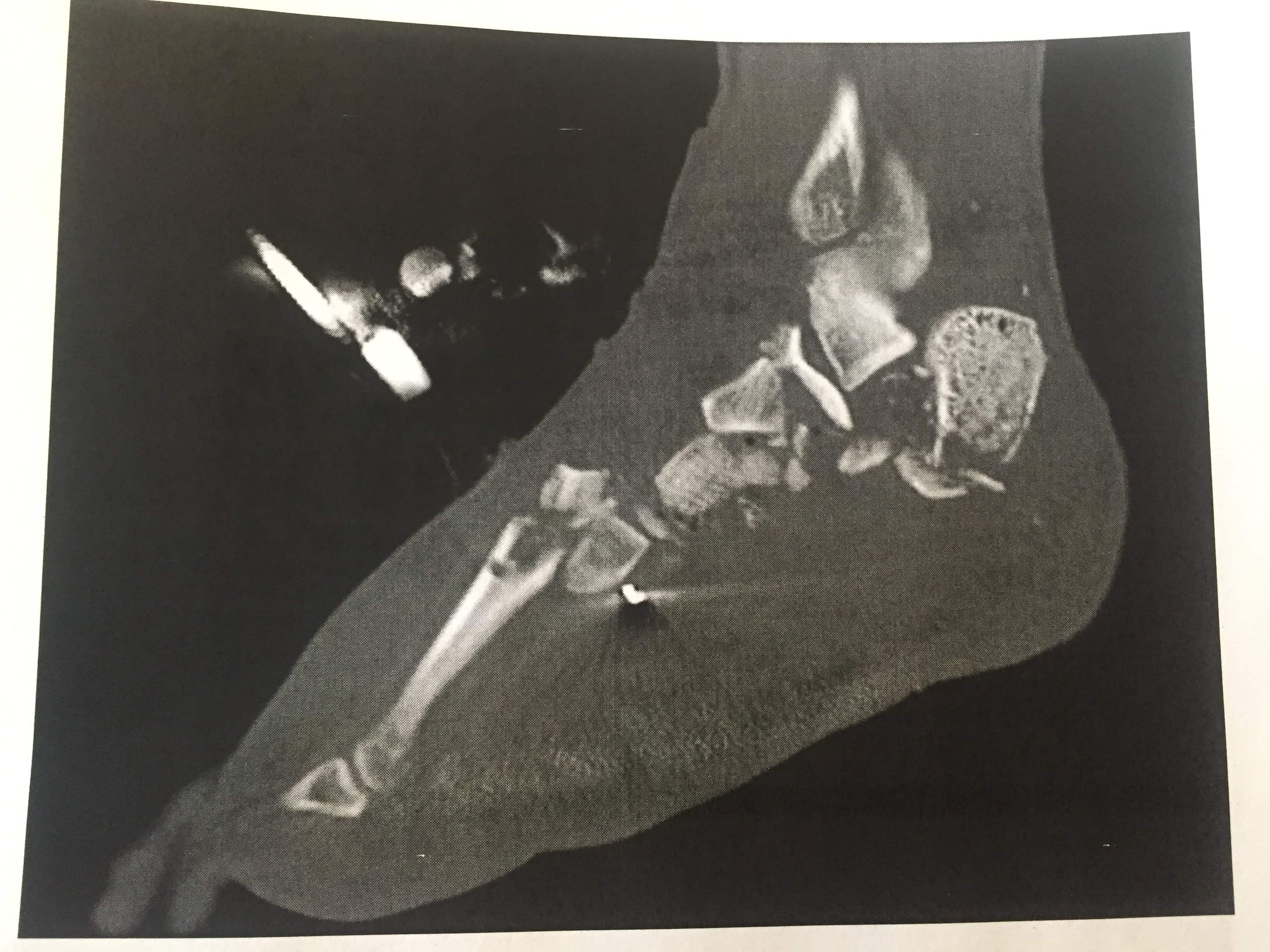 An x-ray of the shattered bones in his leg (Imgur)