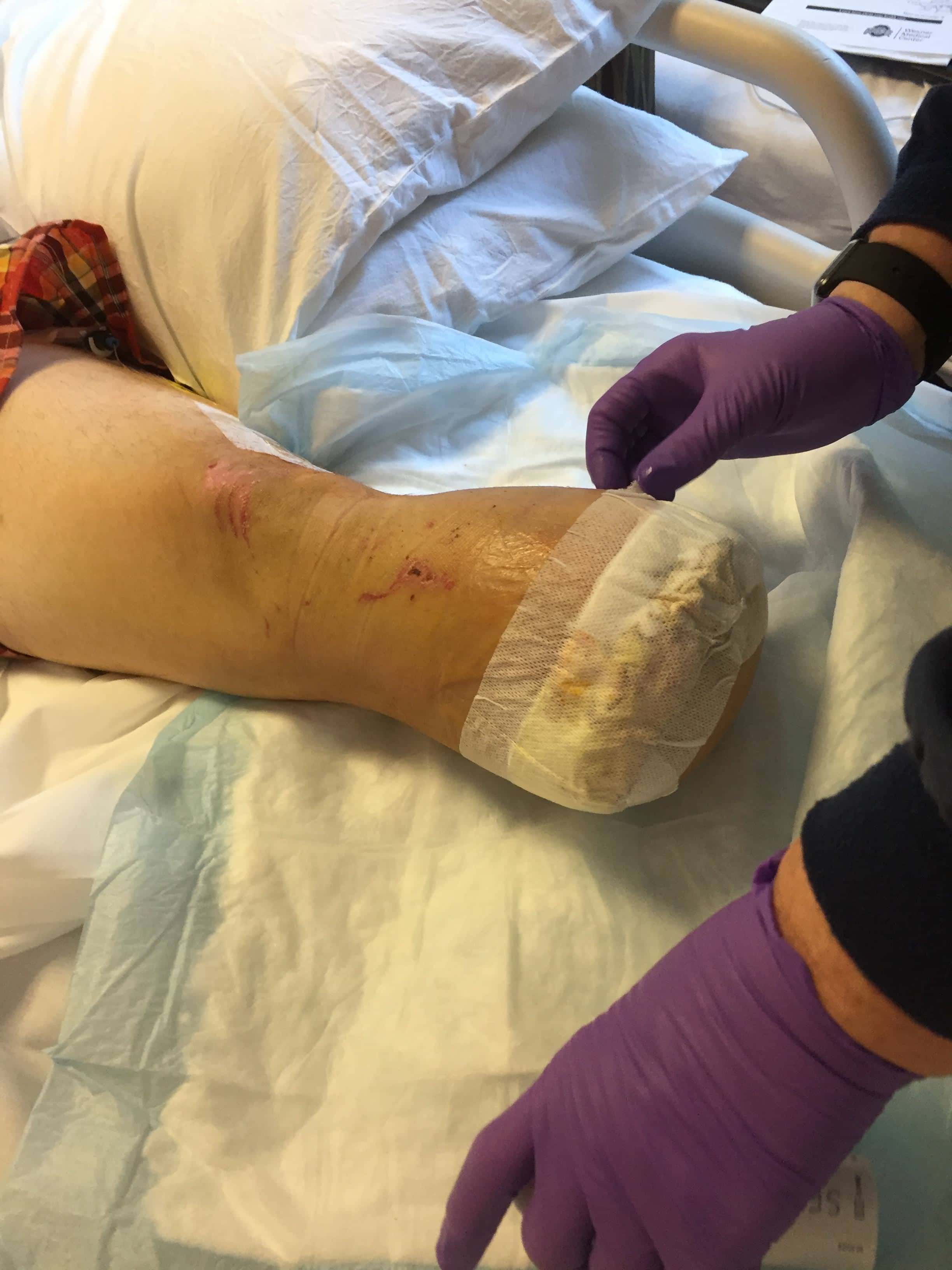After the amputation (Imgur)