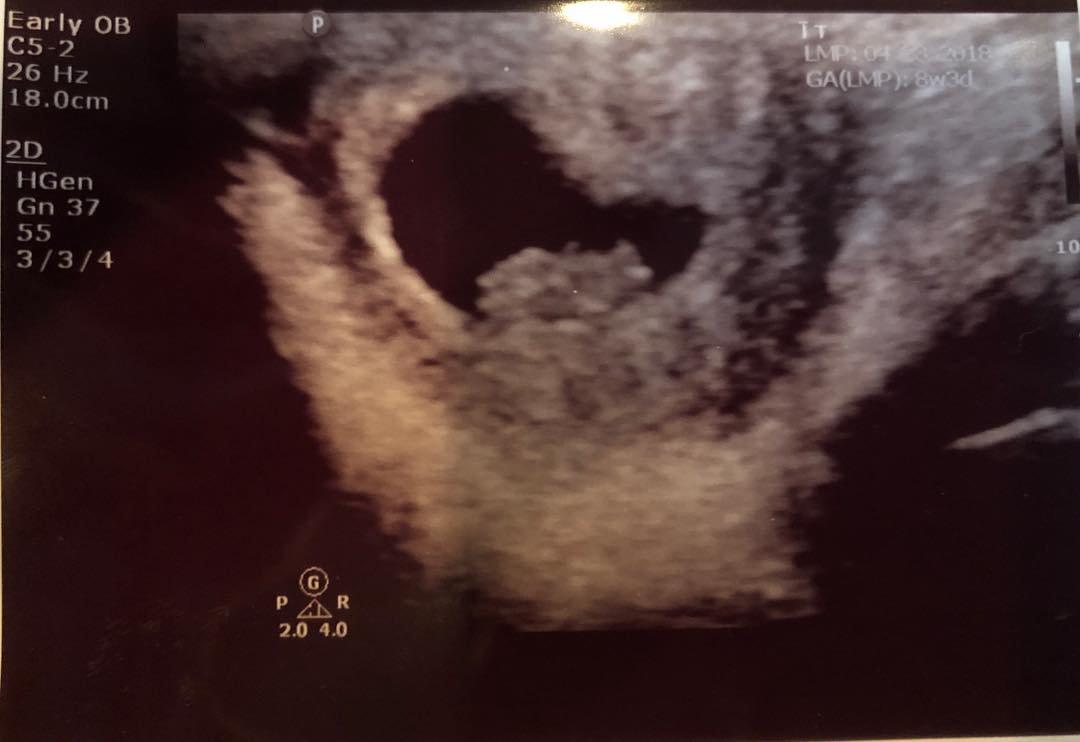 The ultrasound photo posted by XXXTentacion's mother after his death. (Source: Instagram)