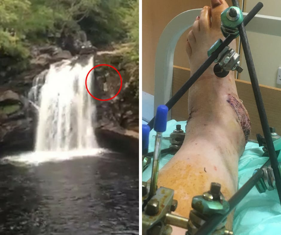 Claire, who wants to warn others of tombstoning, says her foot is still swollen a year on (Image: SWNS)