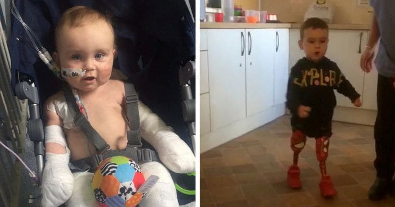 Brave toddler who lost both legs to meningitis takes first solo steps