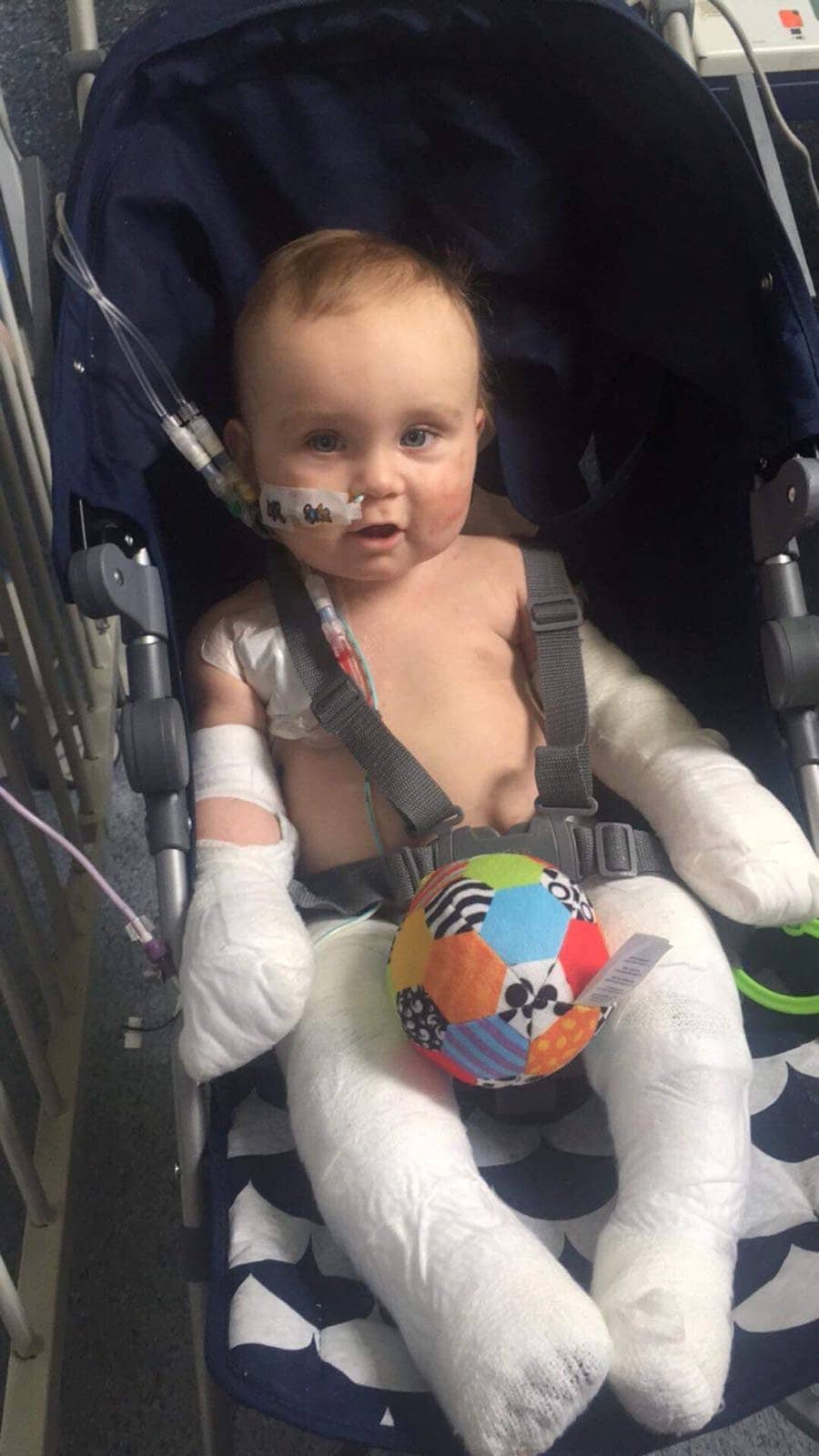 He was diagnosed with meningococcal septicaemia and a rash spread across his whole body and his cheeks (Image: SWNS)