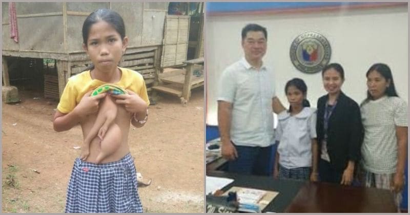 School girl to undergo surgery after living for 14 years with extra arms from her parasitic twin