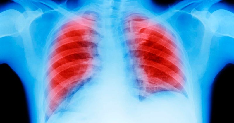 Woman discovers her droopy fingernail was actually a symptom of lung cancer