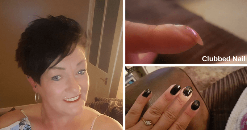 Woman discovers her droopy fingernail was actually a symptom of lung cancer