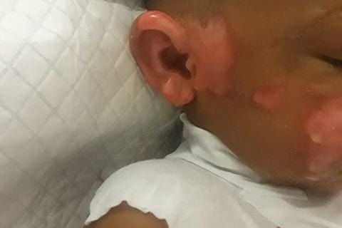 Doctors say that it could take years for the skin to grow back and the skin pigment may be affected (GoFundMe)