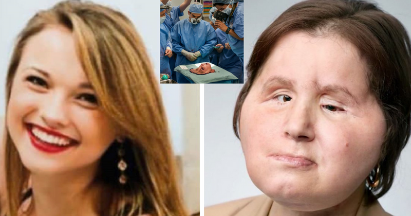 Woman, 21, who shot herself in the head, gets a second chance at life with a face transplant