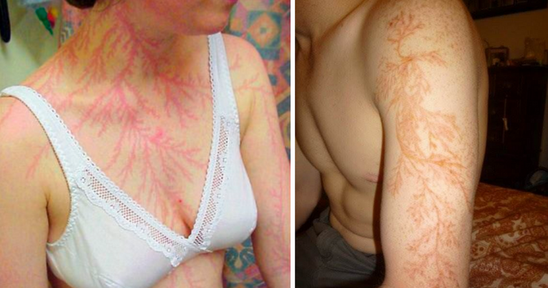 Lichtenberg figures: People share photos of the startling fern-leaf scars left from lightning strikes