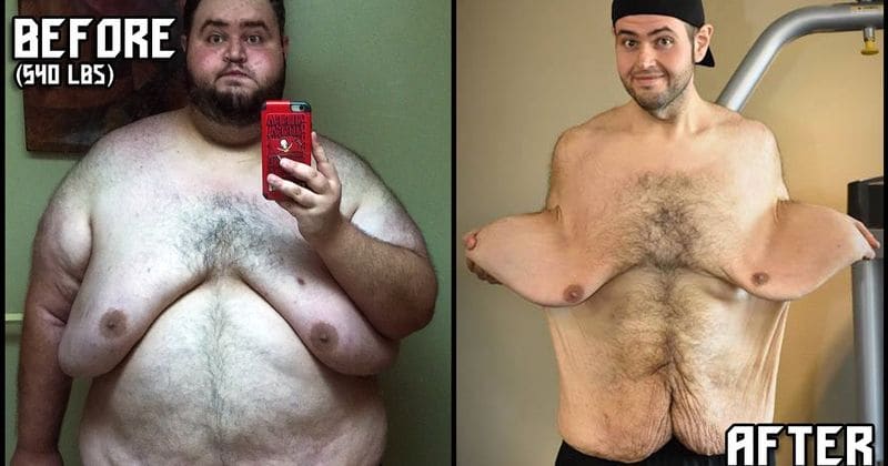 Man with folds of excess skin after dramatic weight loss says it's a 'blessing' to have it removed