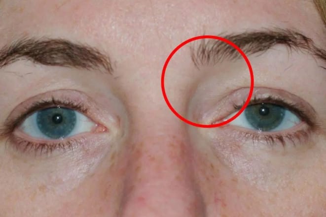 The cyst caused a swelling right above her nose. (BMJ Report)
