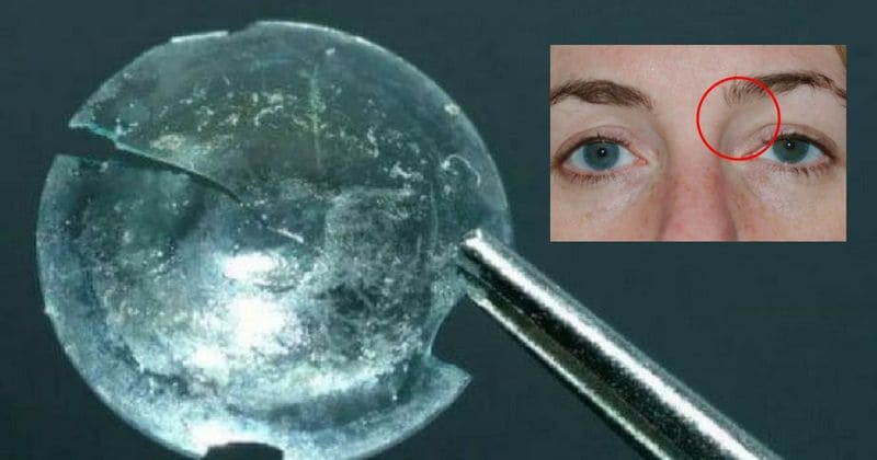 Contact lens found stuck under woman's eyelid 28 years after she thought she had lost it