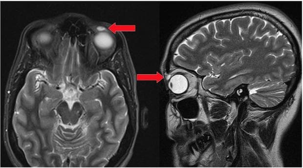 The lens stuck to her upper eyelid for almost 28 years. (BMJ Report)