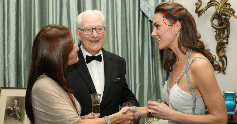 Kate Middleton has a three-inch scar on her head and nobody really knows how she got it