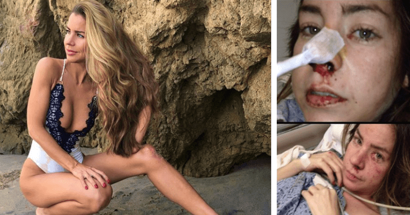 Ex-Playboy model who drank vodka 24 hours a day for a month reveals horror of watching acid in urine eat away her skin