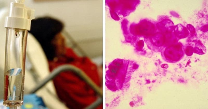In a rare case, three people die of cancer after 'contracting' it from same female organ donor leaving medical community stunned