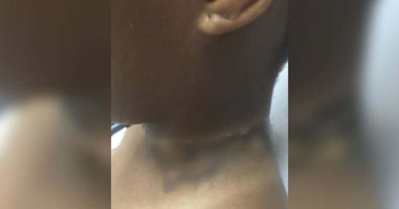iPhone charger causes 2nd degree burns around 19-year-old's neck when it touched her necklace while she was sleeping