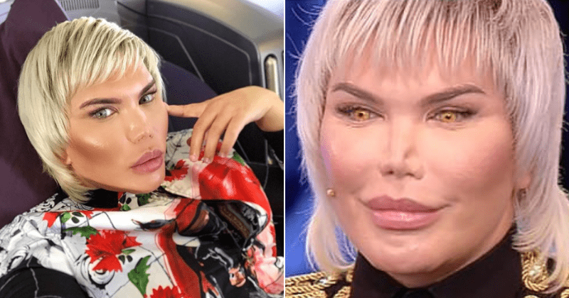 Human Ken Doll to undergo procedure to stop nose from 'sinking' after previous 11 surgeries left it completely destroyed