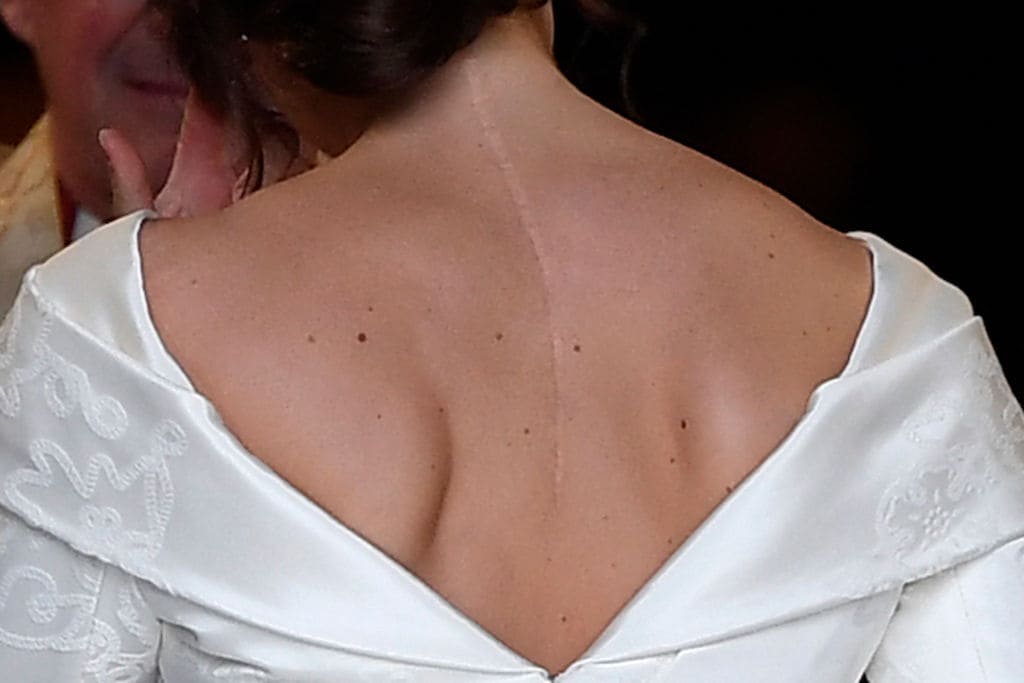 Eugenie did not want to hide the scar from her scoliosis surgery (Getty Images)