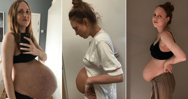 Norwegian mom of triplets shows the ‘reality’ of a new mother’s body on social media in candid snaps
