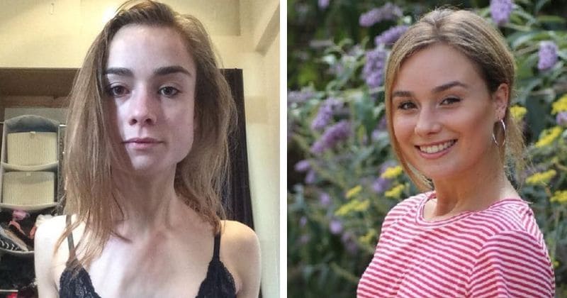 Anorexic ballet dancer whose weight dropped to just 5 stone 9 lbs sought treatment after seeing her dad in tears