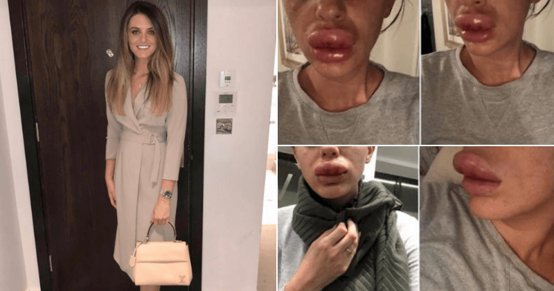 Woman nearly lost her lip after fillers injected at a 'botox party' caused mouth to swell twice its normal size