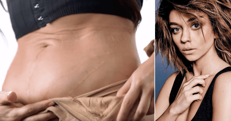 Sarah Hyland shows scars from her 16 surgeries, reveals she had suicidal thoughts after first kidney transplant failed