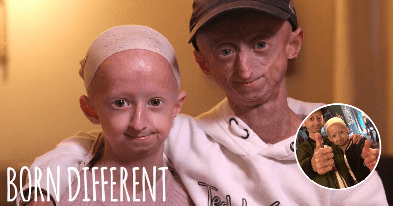 Siblings who are 'ageing 10 times faster' want to be longest living sufferers of rare genetic disorder