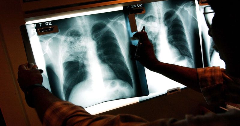 Active tuberculosis can be sniffed out from TB-like diseases in just 30 minutes, thanks to this test