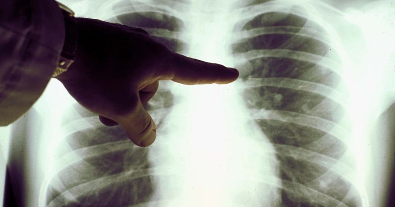 Lung cancer kills more Americans than any other cancer, so why do 21.6% of patients get no treatment at all?