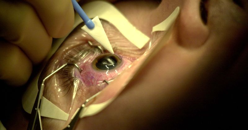 Lasik eye surgery must be stopped says former FDA advisor, claims at least 17 people have committed suicide from the pain