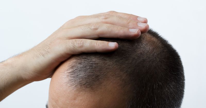 Businessman dies after suffering "severe allergic reaction" to hair transplant surgery