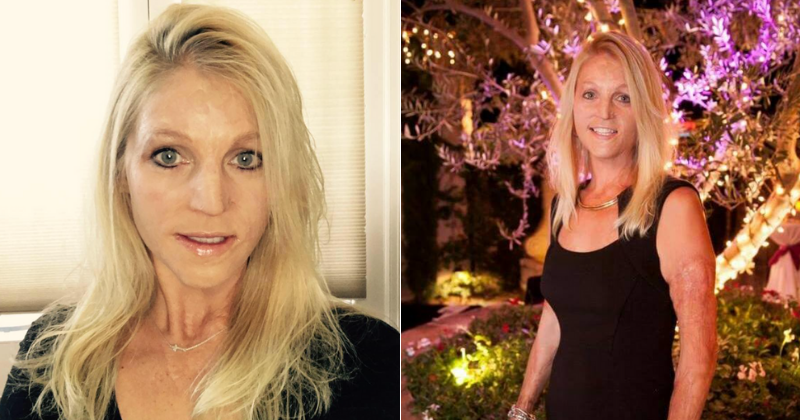 Woman who suffered 70% burns on her body in house fire competes in beauty pageant