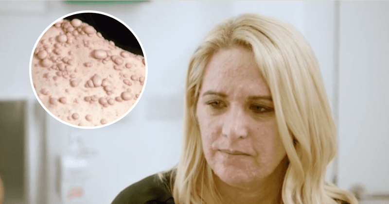 'Save My Skin': Rachael compares her skin to woodchip wallpaper, says she just wants to feel confident again