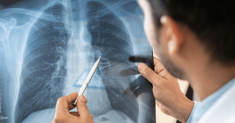 Even mild Covid-19 can be dangerous for lungs as six divers suffer 'irreversible damage' despite recovery