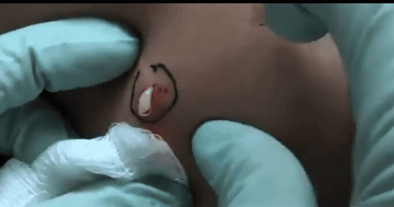 'Dr Pimple Popper': Sandra Lee pops a pimple that oozes out like 'movie theater butter'