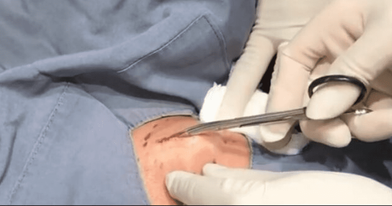 'Dr Pimple Popper': Sandra Lee pops a cyst that looks like potato salad, fans say that's 'vanilla pudding'