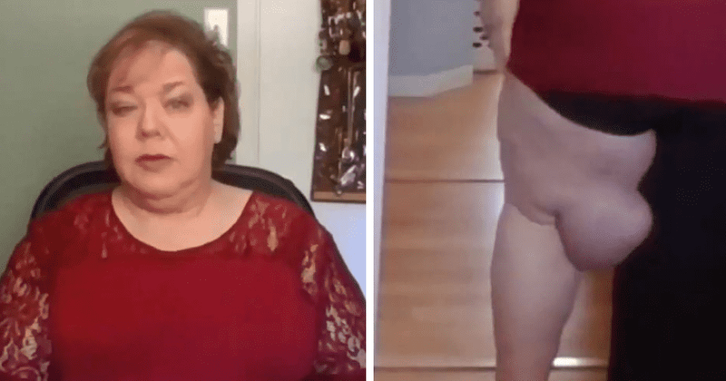 'Dr Pimple Popper': Kelly develops huge mass on leg as she battles flesh-eating bacteria, can Dr Lee help her?
