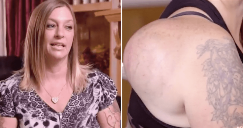 'Dr Pimple Popper': Jacky has a melon-like bump on her shoulder, can Dr Lee get rid of the 'annoying tumor'?