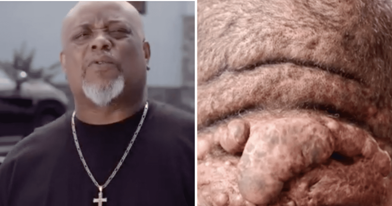 ‘Dr Pimple Popper’ Spoilers: Who is Reginald? Meet the man whose massive ginger-like growth stumped Dr Sandra Lee