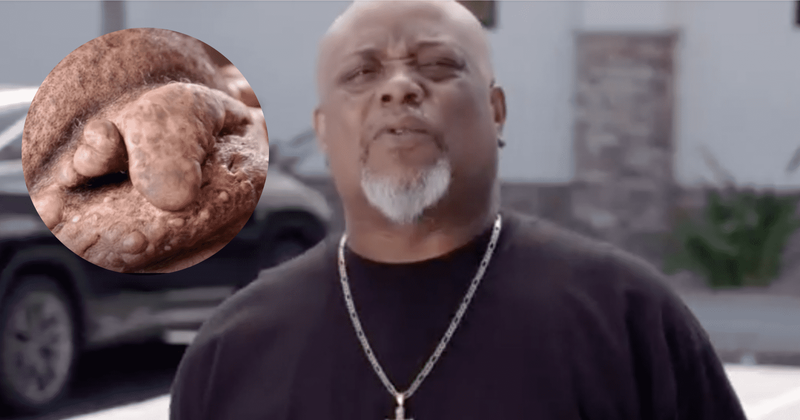 ‘Dr Pimple Popper’: Reginald’s ginger-like cyst sees Dr Sandra and Dr Sanusi join forces, will they succeed?