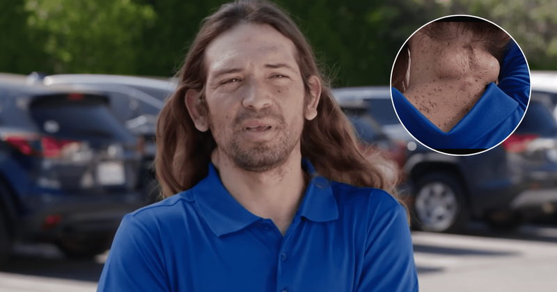 ‘Dr Pimple Popper’: Who is Juan? Dr Lee surprised by amount of mashed potato-like pus coming out of his cysts