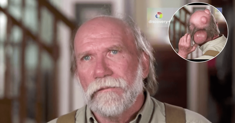 'Dr Pimple Popper': Will Dennis be able to get rid of bumps on his head that looked like 'ticking atom bombs'?
