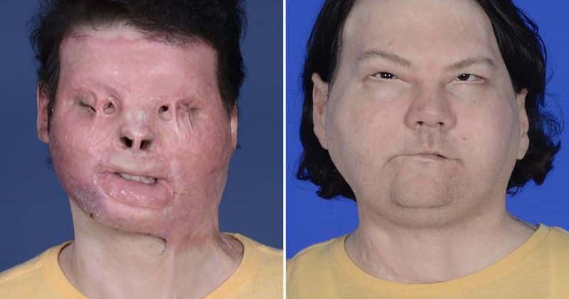 Who is Joe DiMeo? New Jersey burn survivor becomes world's 1st person to get successful face and hands transplant