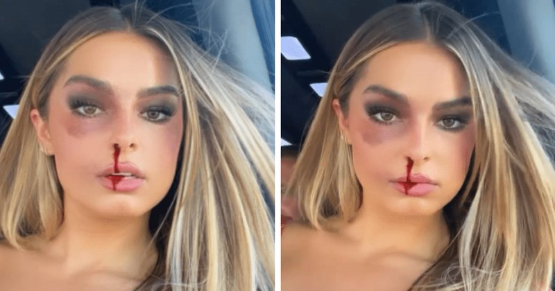Is Addison Rae OK? Fans worry after she posts video with black eye and nosebleed