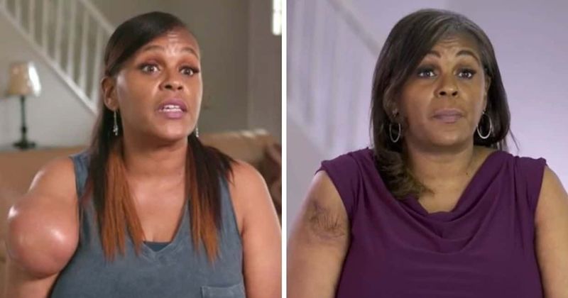 Where is Stacey now? 'Dr Pimple Popper' vegan patient blamed 5 lb lipoma on soya diet